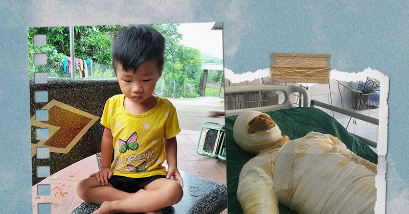 Bác sĩ kêu gọi giúp người đàn ông bị bỏng nặng không có bảo hiểm nuôi 5 con nhỏ