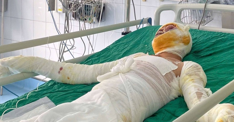 Bố vừa mất, con trai bỏng nặng: Cha nghèo chỉ có 1,2 triệu đồng đưa con đi viện
