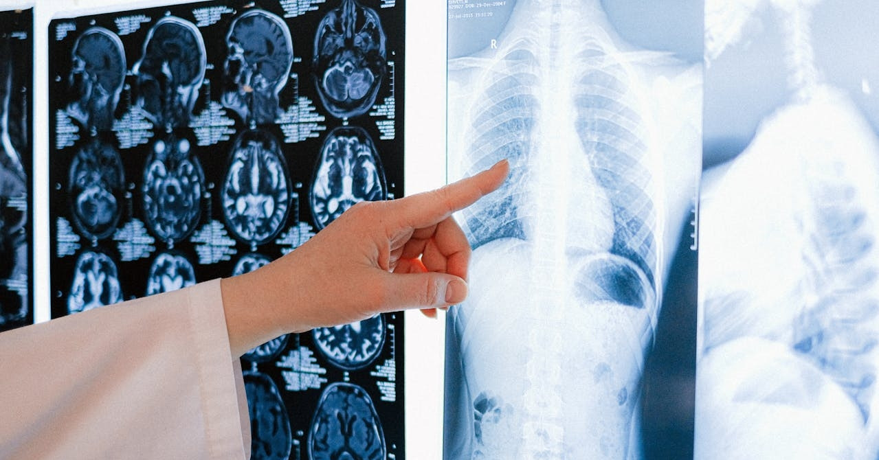 HLV thể hình ăn uống kỷ luật vẫn bị ung thư, bác sĩ chỉ ra thói quen nguy hại