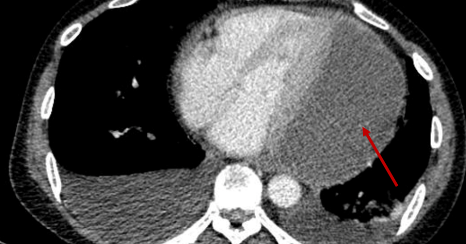 Trái tim người đàn ông ‘bơi’ trong ổ dịch mủ, sự sống đe dọa từng giây