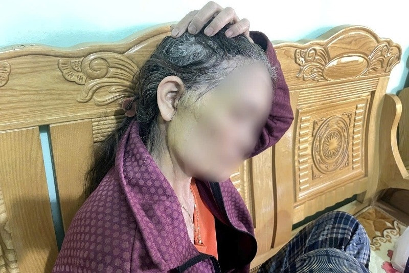 Người phụ nữ 64 tuổi đi thẩm mỹ căng da mặt gặp biến chứng nghiêm trọng