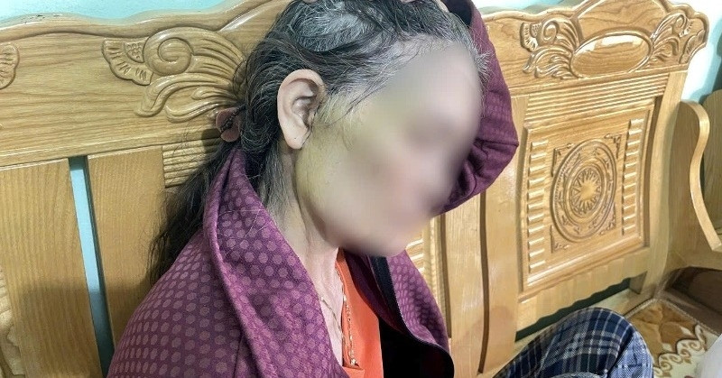 Người phụ nữ 64 tuổi đi thẩm mỹ căng da mặt gặp biến chứng nghiêm trọng