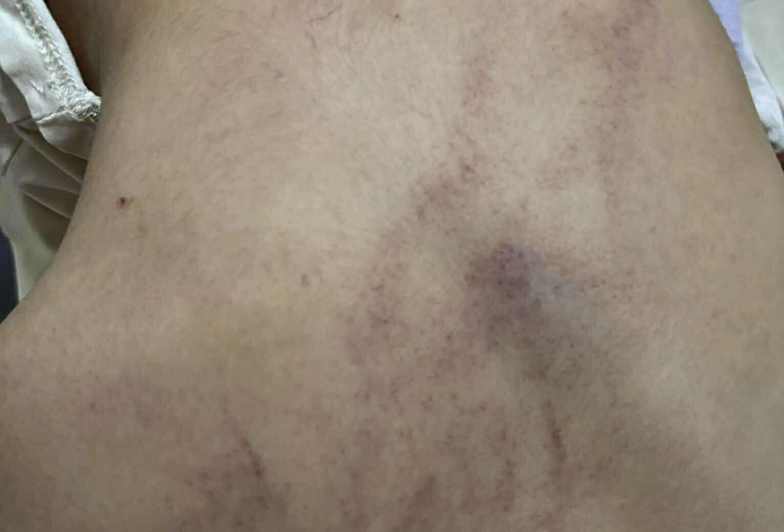 Bộ Y tế vào cuộc, trưng cầu giám định bé 4 tuổi bị cô giáo bạo hành