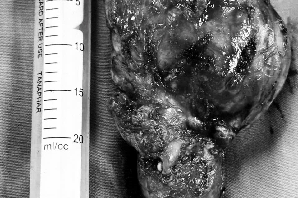 Khối u 'khủng' tồn tại hơn 20 năm trên cơ thể người phụ nữ Ninh Bình