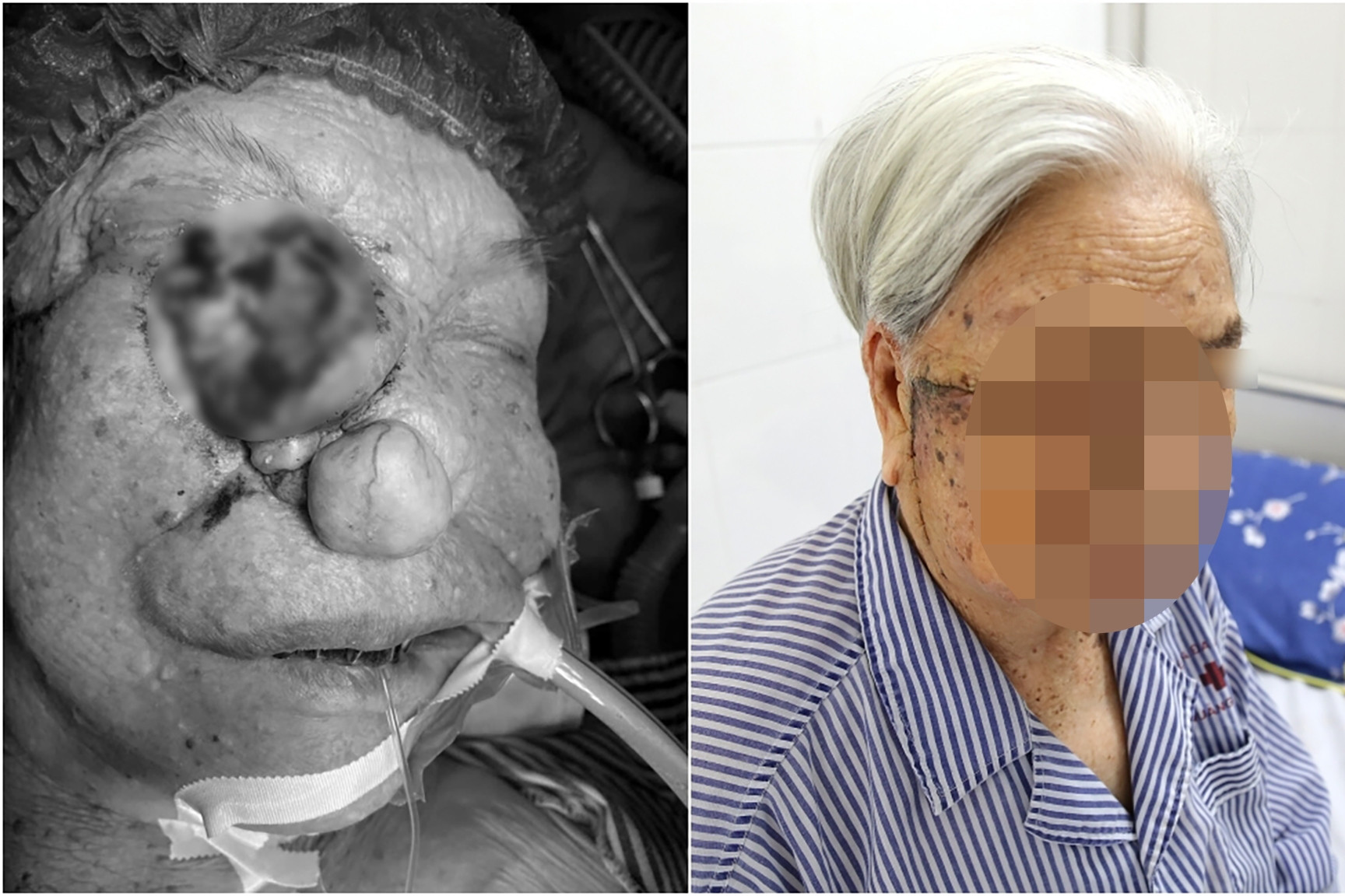 Phẫu thuật khối u lớn làm biến dạng mặt cụ bà 96 tuổi