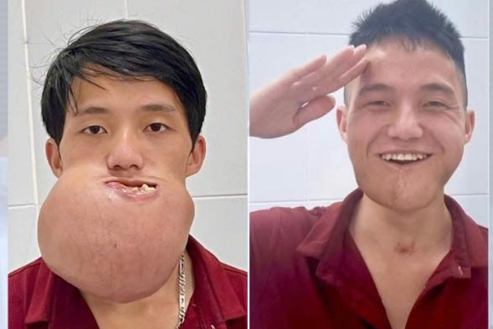 Ca phẫu thuật kéo dài 10 giờ tìm lại nụ cười cho chàng trai trẻ