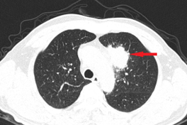 Người đàn ông phát hiện cùng lúc 2 bệnh ung thư từ dấu hiệu rất nhẹ