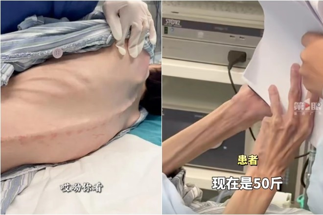 Người phụ nữ 39 tuổi chỉ nặng 25kg, gầy trơ xương vì giảm cân quá đà