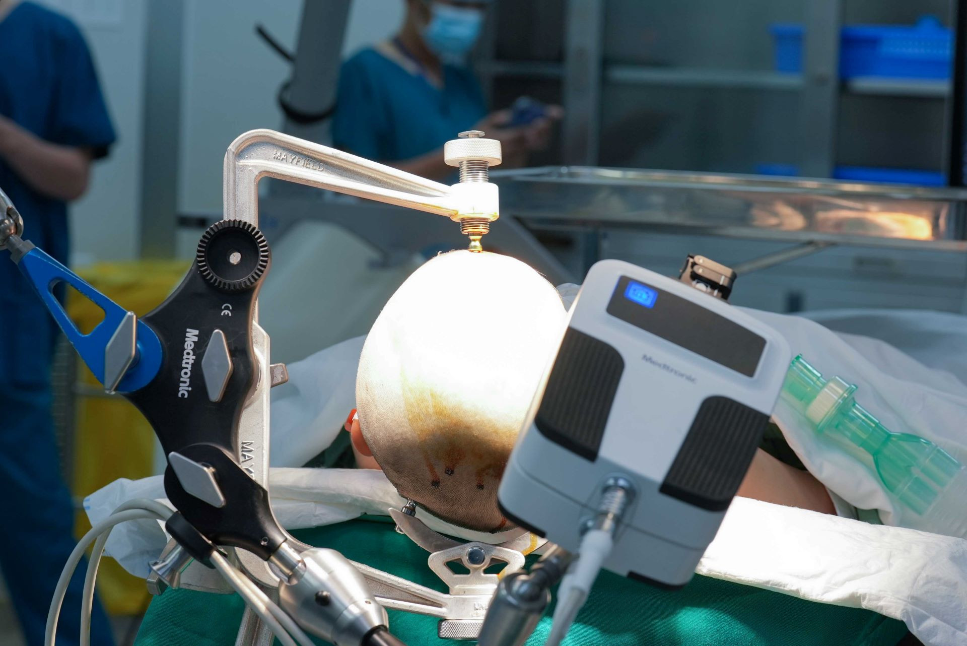 Vinmec tiên phong điều trị động kinh bằng Robot định vị thần kinh