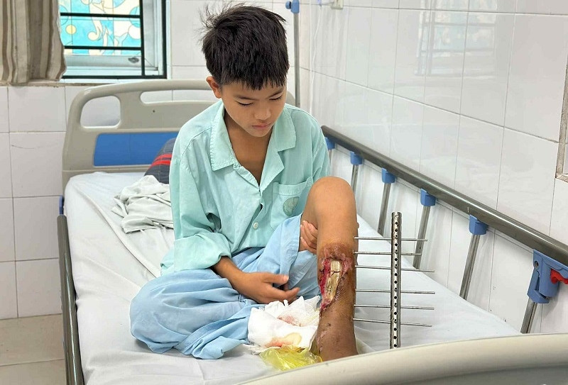 Bán cả đàn gà để cứu con, anh Páo bất lực nhìn con trai có nguy cơ mất chân