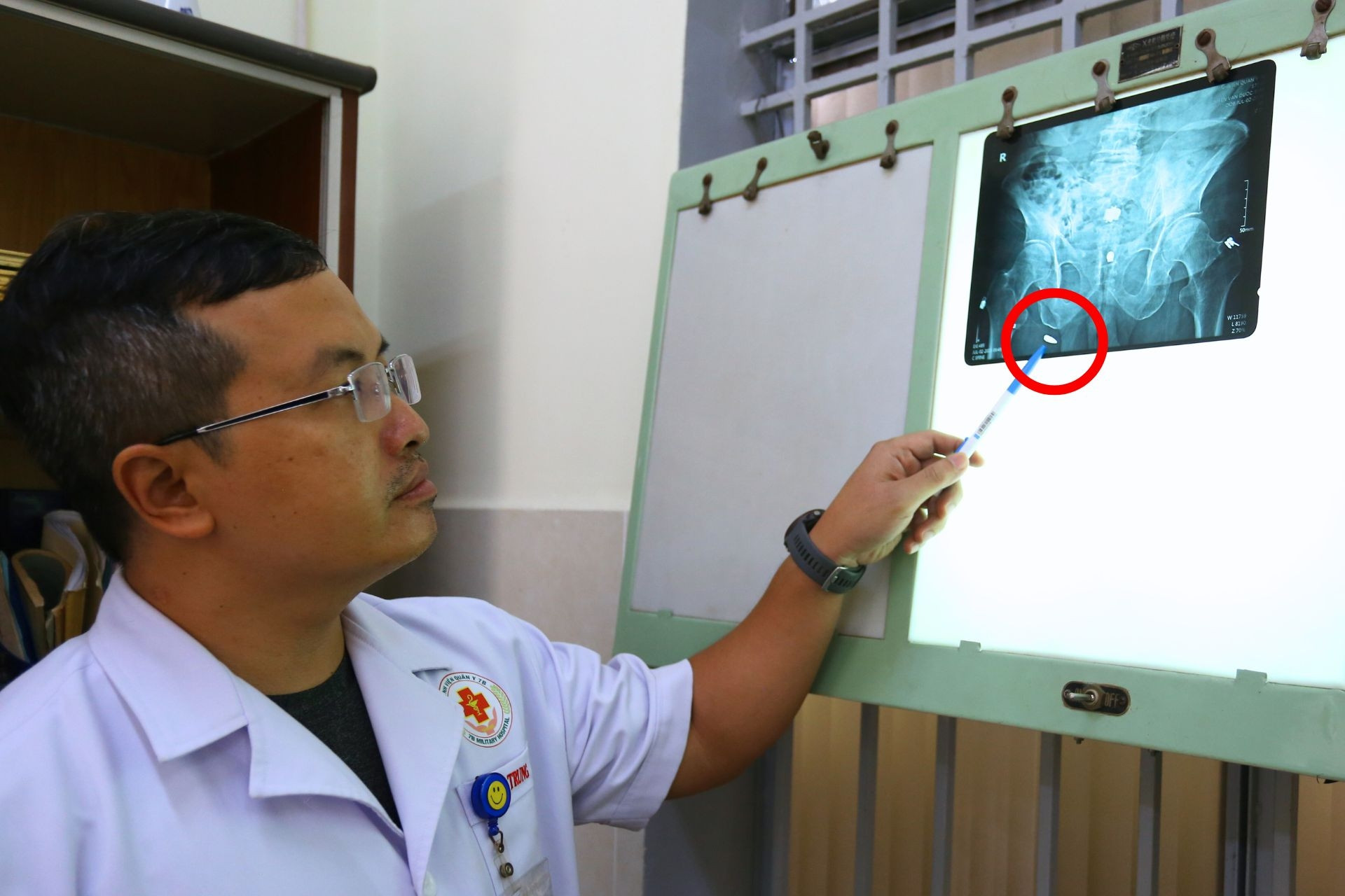 Bất ngờ tìm thấy dị vật 'ngủ quên' hơn 6 thập kỷ trong người cụ ông