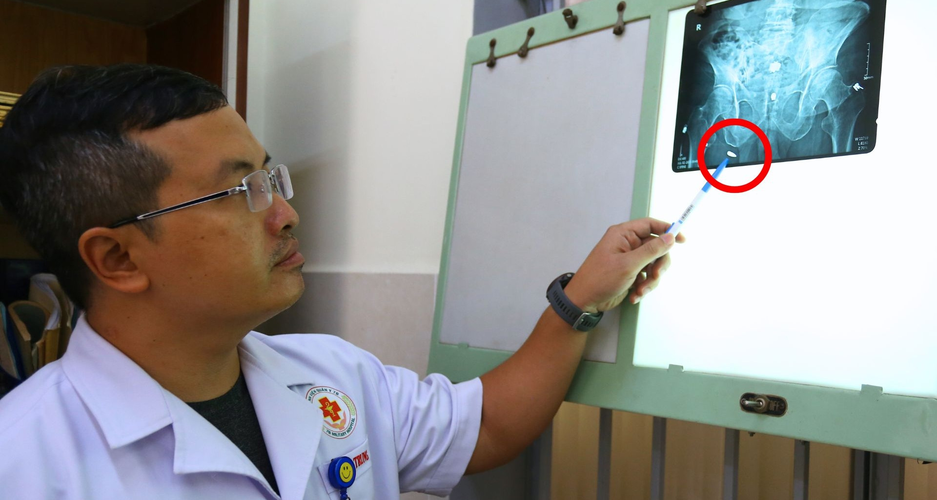 Bất ngờ tìm thấy dị vật 'ngủ quên' hơn 6 thập kỷ trong người cụ ông