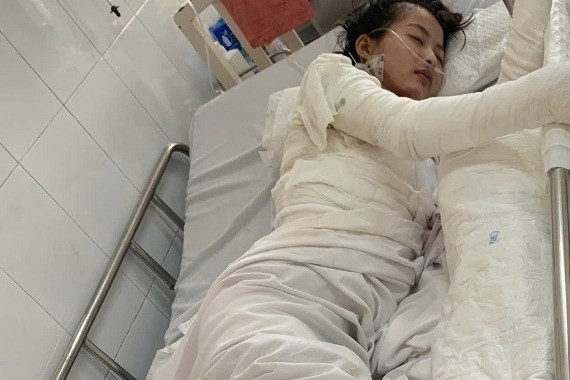 Cần lắm những bàn tay nâng đỡ nữ sinh bị bỏng nặng, trải qua 12 lần ghép da