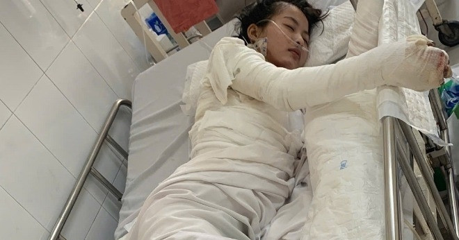 Cần lắm những bàn tay nâng đỡ nữ sinh bị bỏng nặng, trải qua 12 lần ghép da