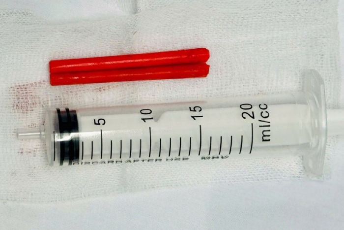 Hai đoạn đũa nhựa dài 5–6cm trong mũi người đàn ông suốt hơn 1 năm