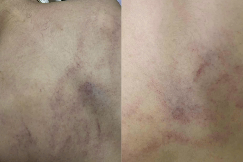 Phụ huynh ở Hà Nội tố giáo viên đánh trẻ mầm non bầm tím lưng