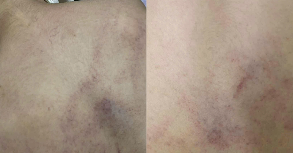 Phụ huynh ở Hà Nội tố giáo viên đánh trẻ mầm non bầm tím lưng