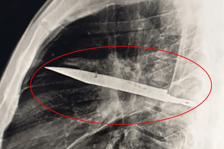 Người đàn ông không hay biết có lưỡi dao lớn mắc kẹt trong ngực suốt 8 năm