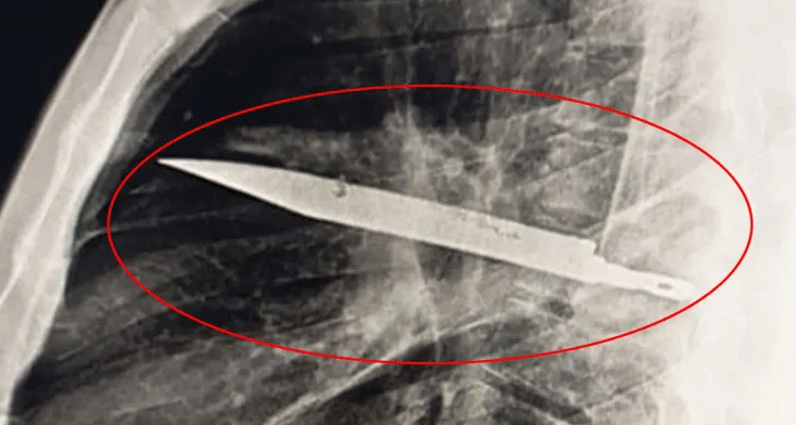 Người đàn ông không hay biết có lưỡi dao lớn mắc kẹt trong ngực suốt 8 năm