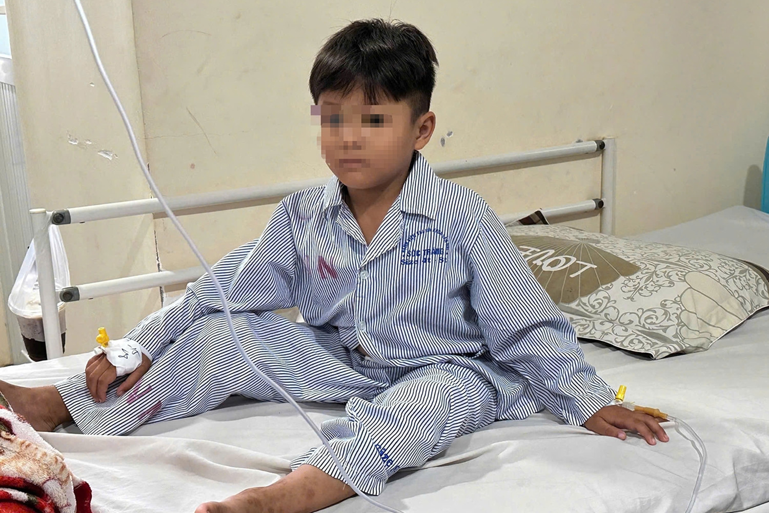 Bé trai 6 tuổi bị thủng ruột khi nuốt phải 4 viên nam châm