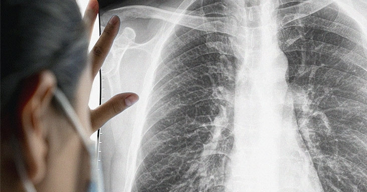 Người vợ mắc ung thư giai đoạn cuối do thói quen của chồng