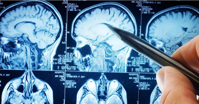 Phát hiện có khối u não nhờ cảnh báo của đồng hồ đeo tay