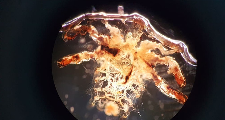 Rận làm tổ chi chít trên mi mắt người phụ nữ