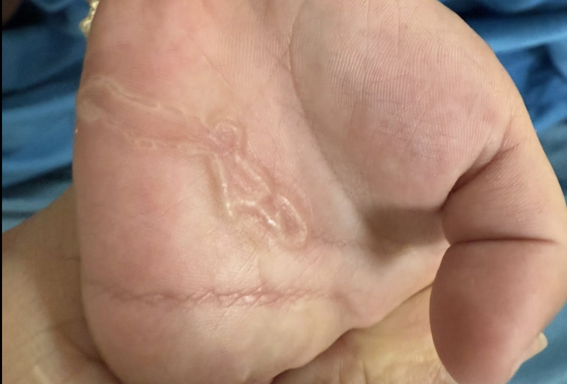 Bàn tay bé trai xuất hiện dấu hiệu lạ sau lần nghịch cát