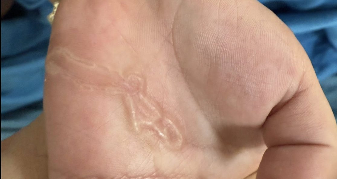 Bàn tay bé trai xuất hiện dấu hiệu lạ sau lần nghịch cát