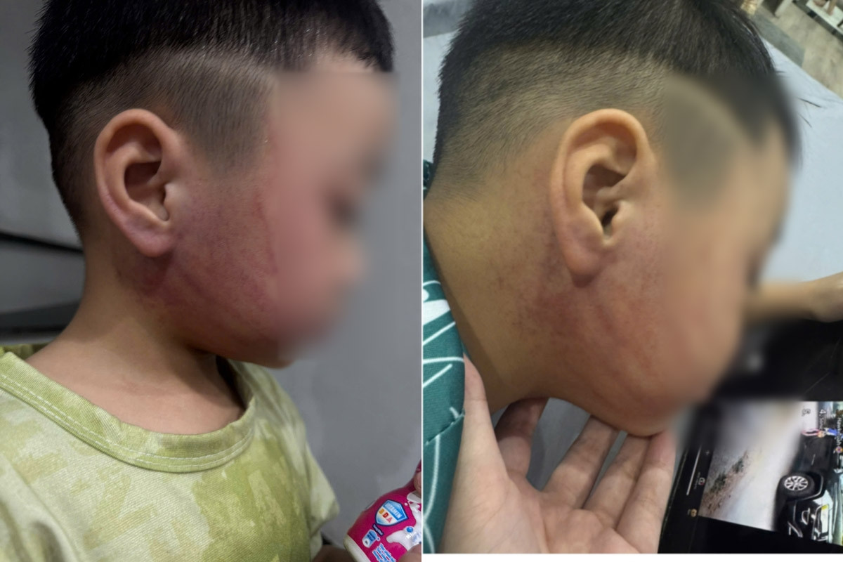 Bé 4 tuổi nghi bị giáo viên mầm non ở Hà Nội đánh bầm tím mặt