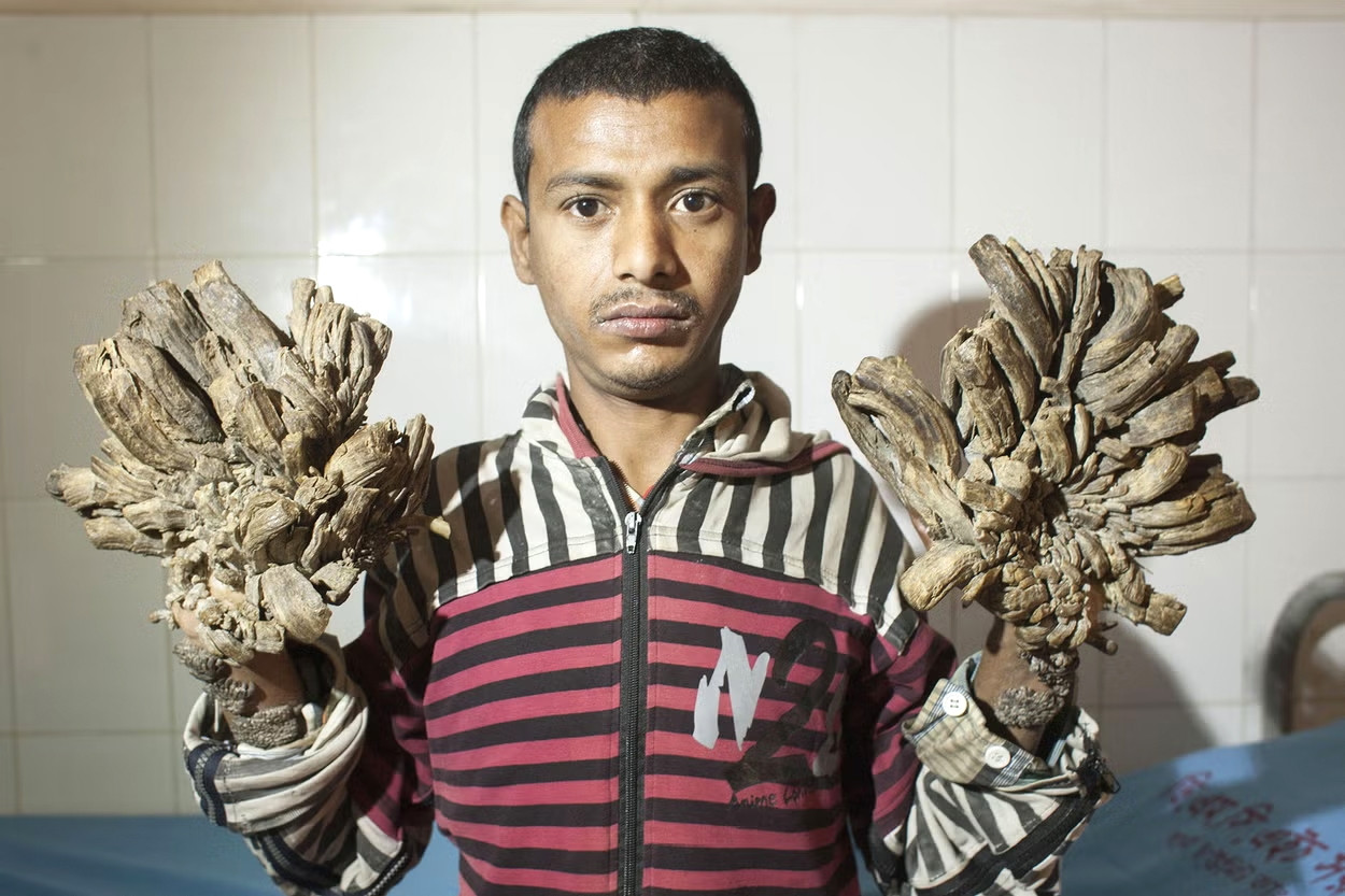 Nguyên nhân khiến nam thanh niên có tay chân 'hóa gỗ'