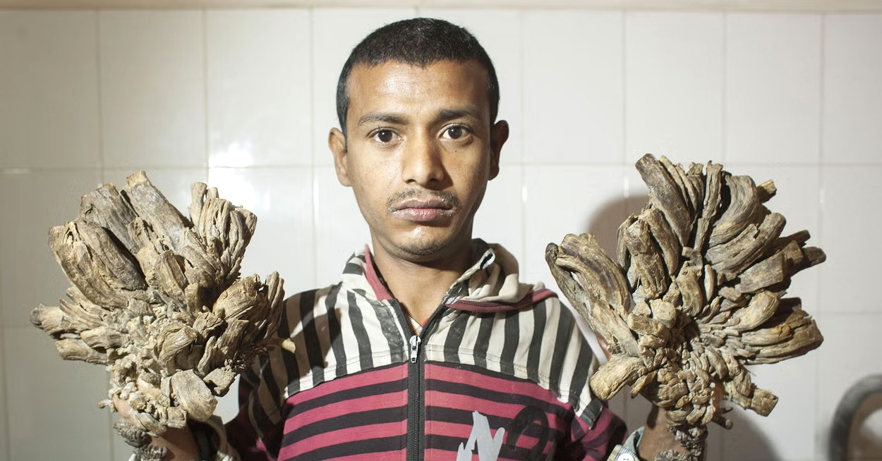 Nguyên nhân khiến nam thanh niên có tay chân "hóa gỗ"