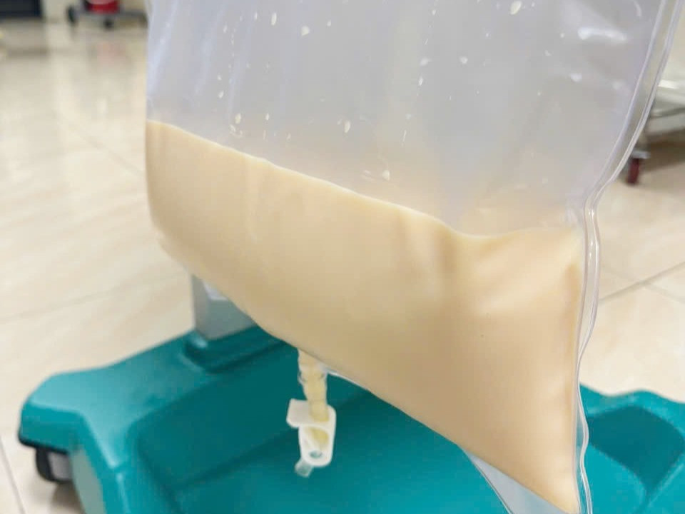 Lọc máu cứu người đàn ông có huyết tương đục như sữa