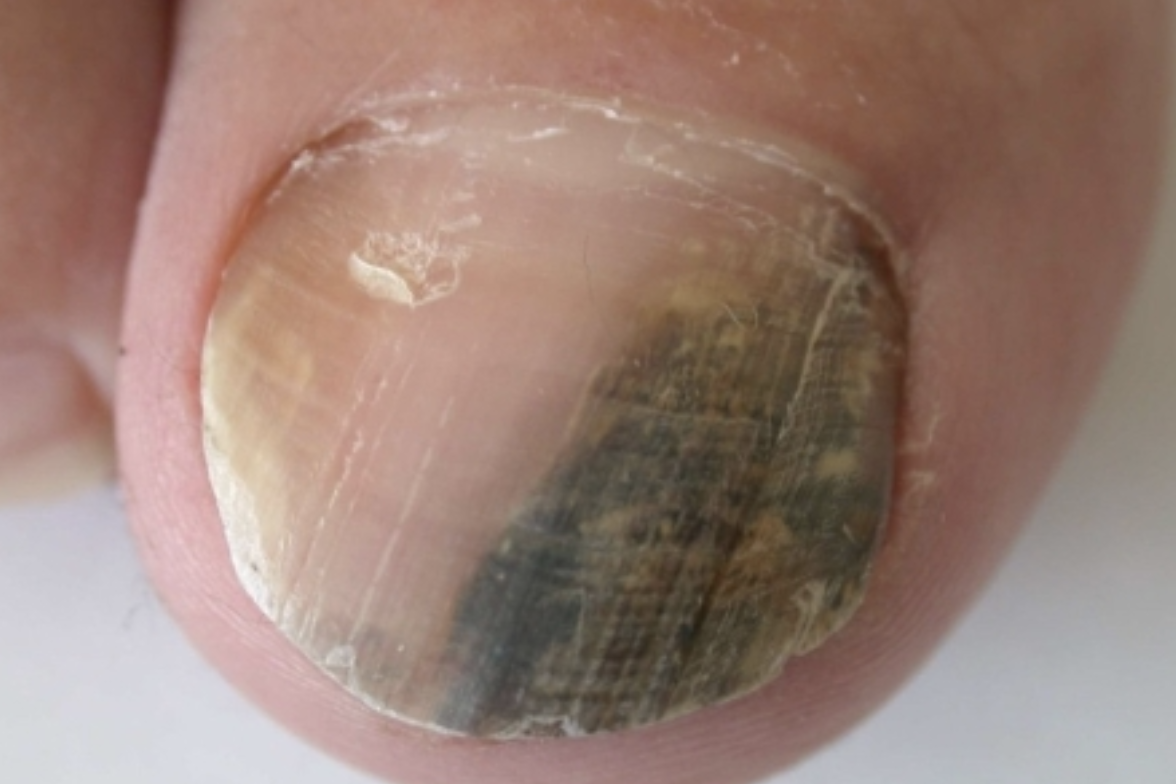 Căn bệnh ung thư tiên lượng xấu có thể bắt đầu từ một dải đen, thẳng ở móng