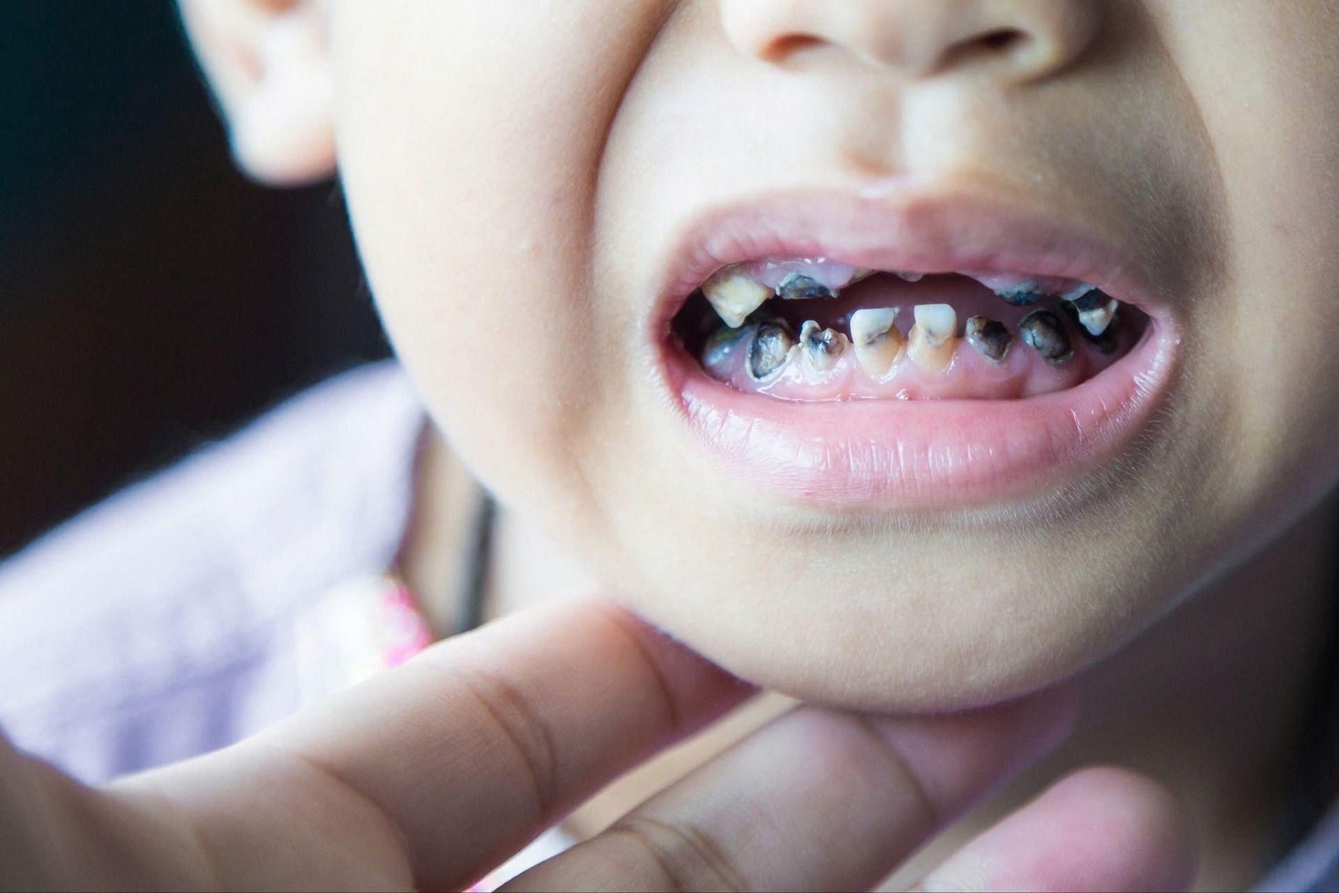 4 lý do khiến trẻ ngày nay bị sâu răng sữa sớm hơn trước