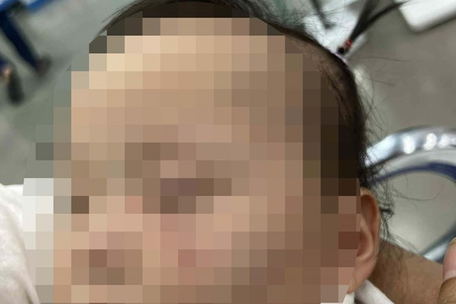 Bé gái bị bầm tím mặt khi theo học tại trường mầm non tư thục