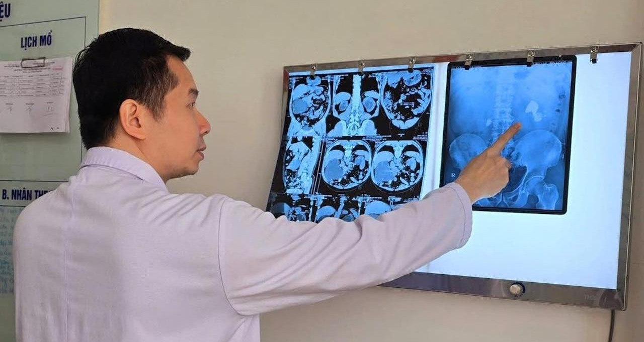 4 năm trì hoãn "chưa đau thì không sao", người đàn ông đối diện hỏng 1 quả thận