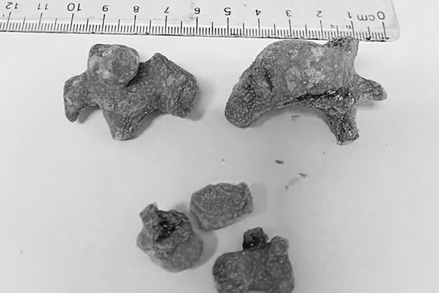 Phẫu thuật lấy sỏi thận cỡ lớn như san hô cho nữ bệnh nhân 55 tuổi