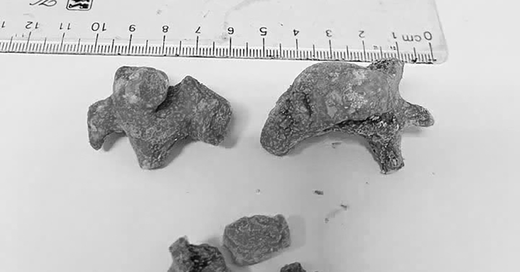 Phẫu thuật lấy sỏi thận cỡ lớn như san hô cho nữ bệnh nhân 55 tuổi