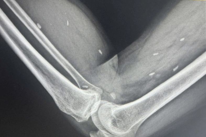 Hình ảnh X-quang gây sốc ở người đàn ông có thói quen ăn đồ sống