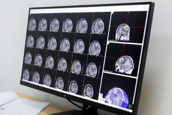 Người đàn ông suy đa tạng, nguy kịch sau bữa tiệc Não di lệch sang phải sau cú vấp nhẹ