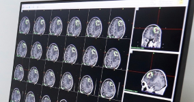 Não di lệch sang phải sau cú vấp nhẹ