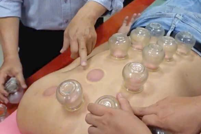 Đột quỵ nặng khi nhờ chị gái giác hơi