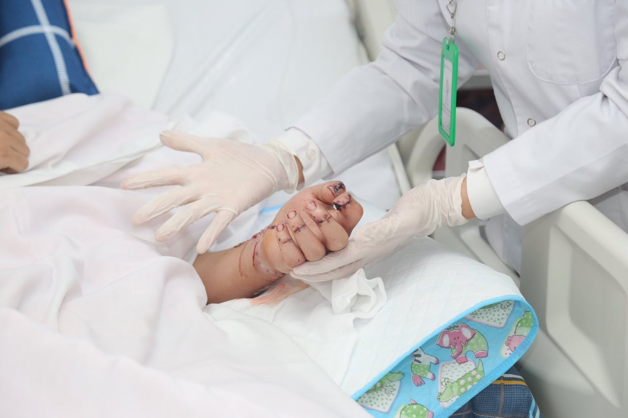 Nối bàn tay bị chém đứt rời cho thanh niên 19 tuổi