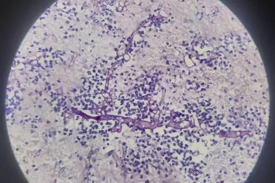 Người đàn ông bị nấm đen xâm lấn não