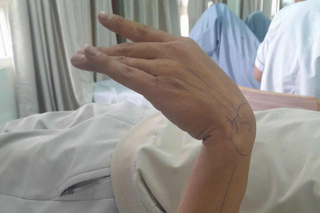 Tỉnh dậy sau giấc ngủ gật, nam nhân viên văn phòng bất ngờ liệt bàn tay