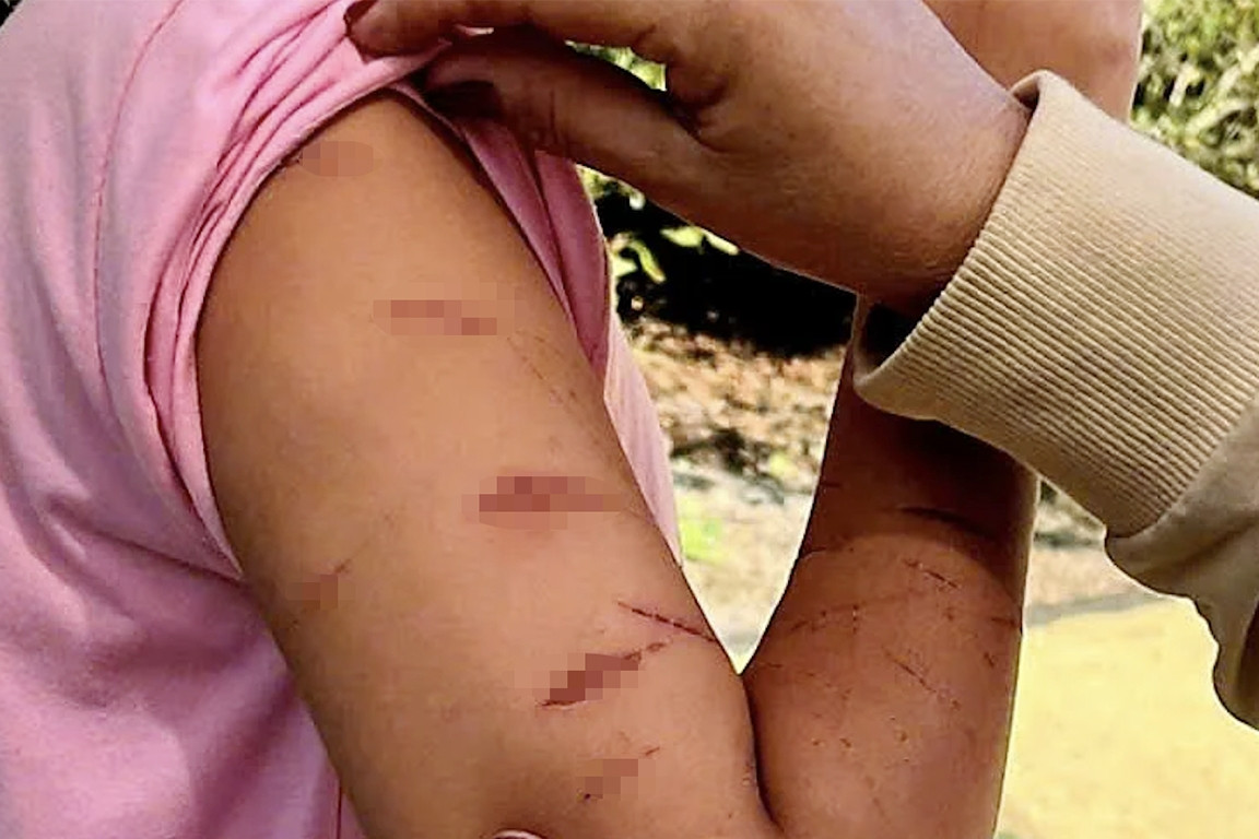 Bé gái 12 tuổi đến trường với vết thương trên tay, giáo viên lập tức báo công an