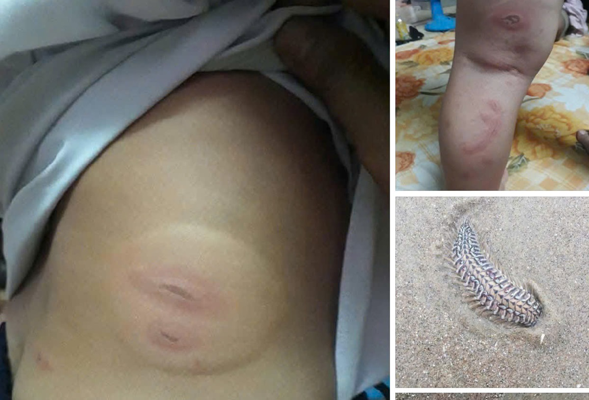 Bệnh viện lên tiếng về thông tin sâu biển cắn bé 3 tuổi nguy kịch, cần truyền máu gấp