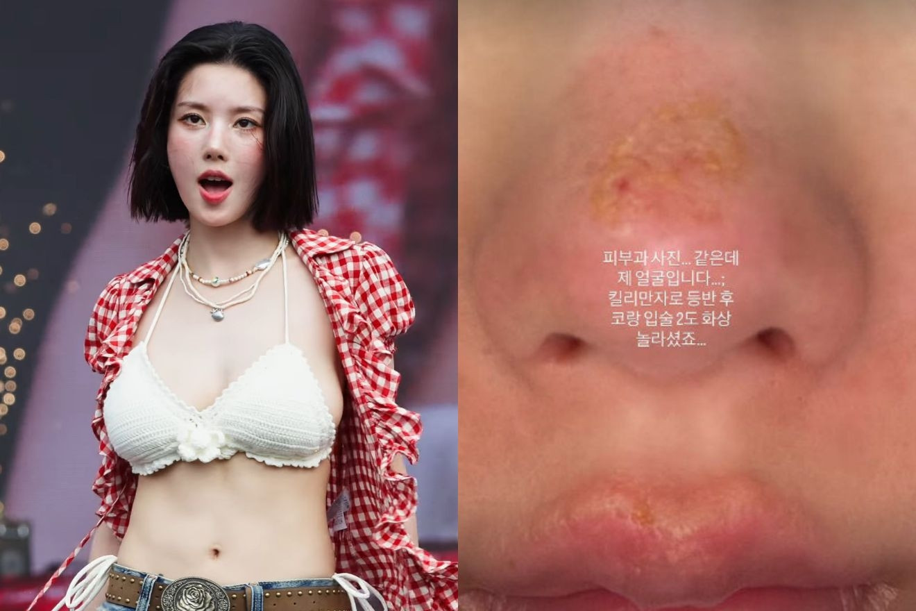 Nữ ca sĩ 31 tuổi bị bỏng nặng sau chuyến leo núi