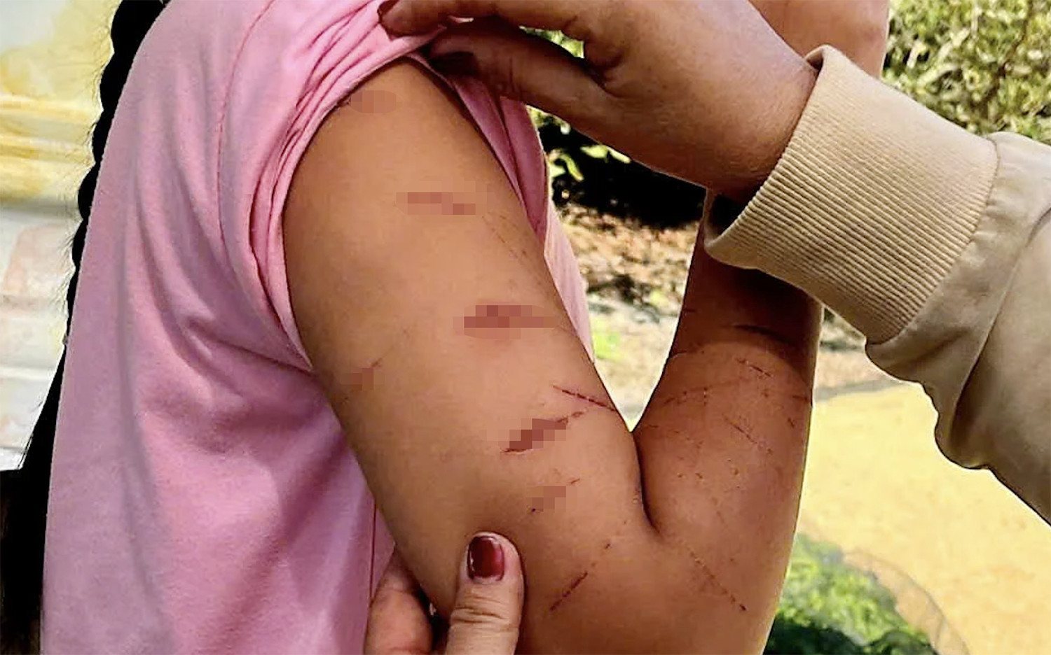 vet thuong tren nguoi nu sinh 946.jpg